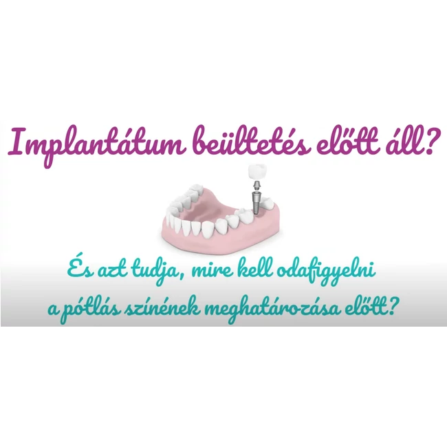 Implantátum beültetés előtt áll?